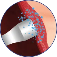 Cobertura abluminal - Polímero 100% biodegradável