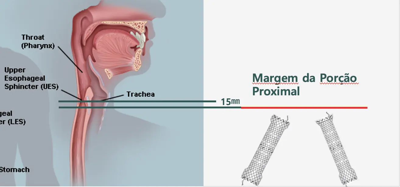 NESC – Total coberto cervical - Hanaro Stent