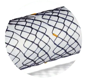 NESC – Total coberto cervical - Hanaro Stent